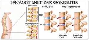 pengobatan ankilosis